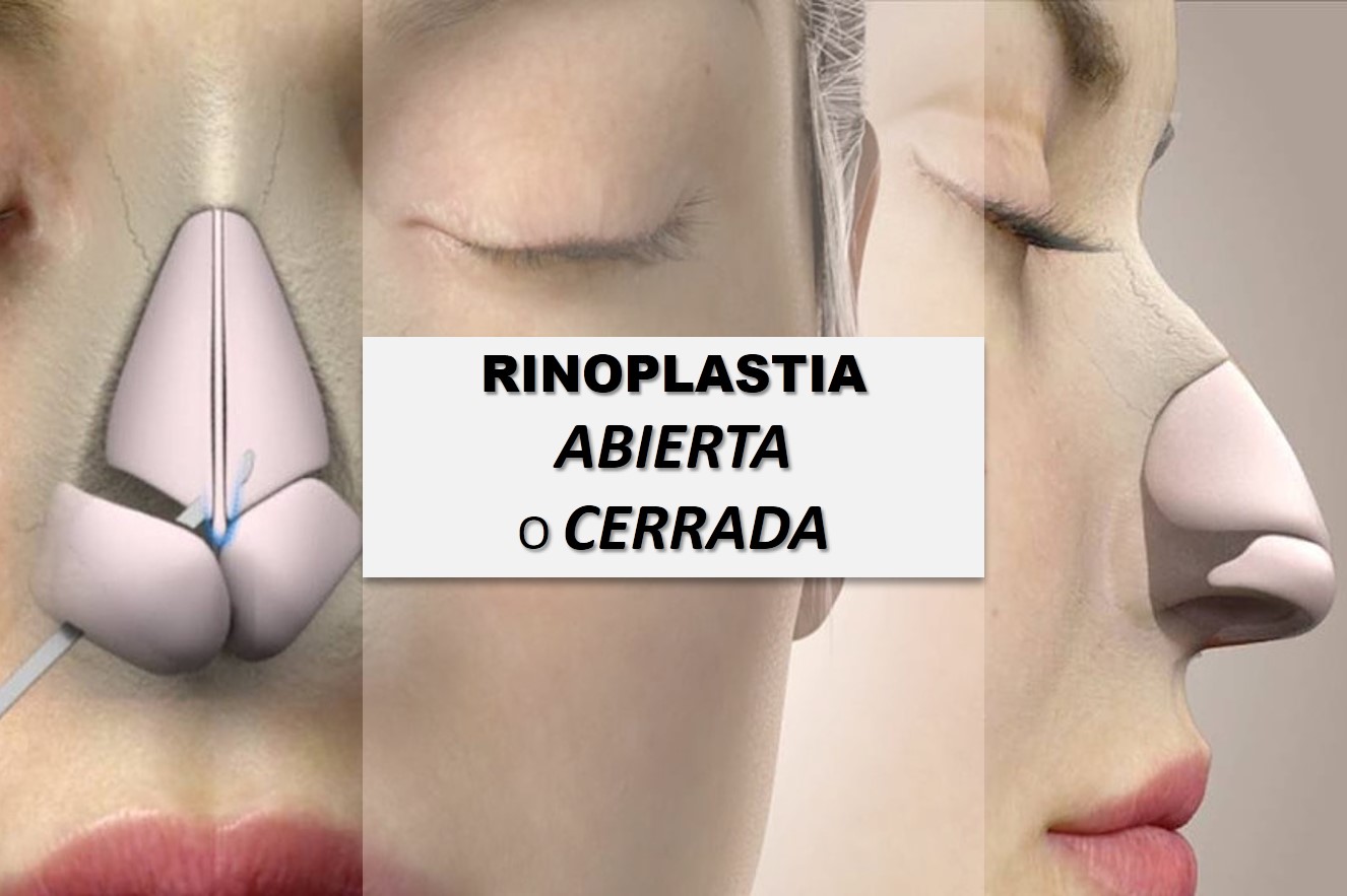 rinoplastia abierta o cerrada destacada