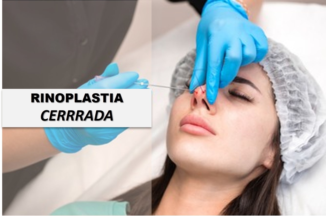 rinoplastia cerrada destacada