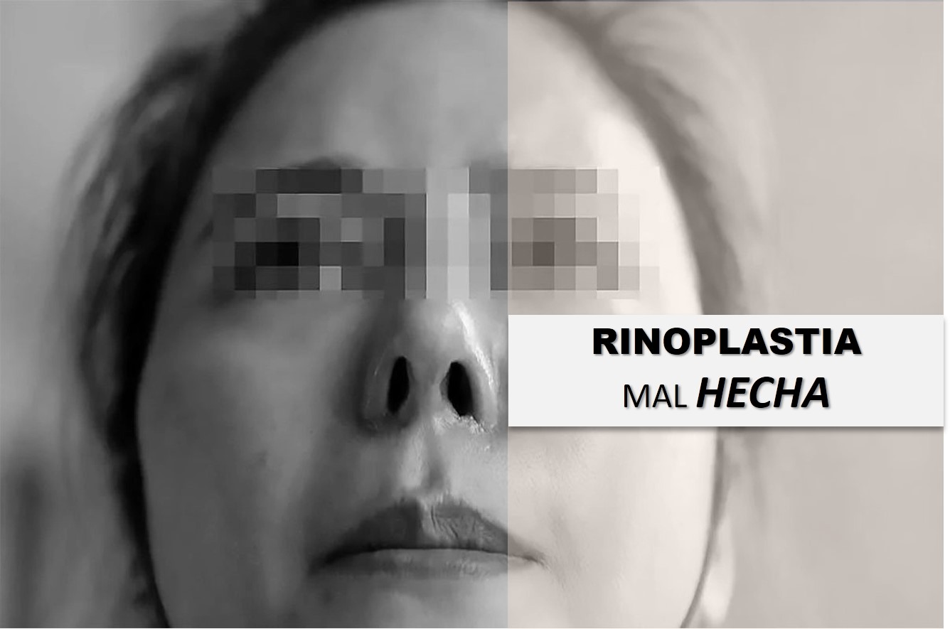 rinoplastia mal hecha