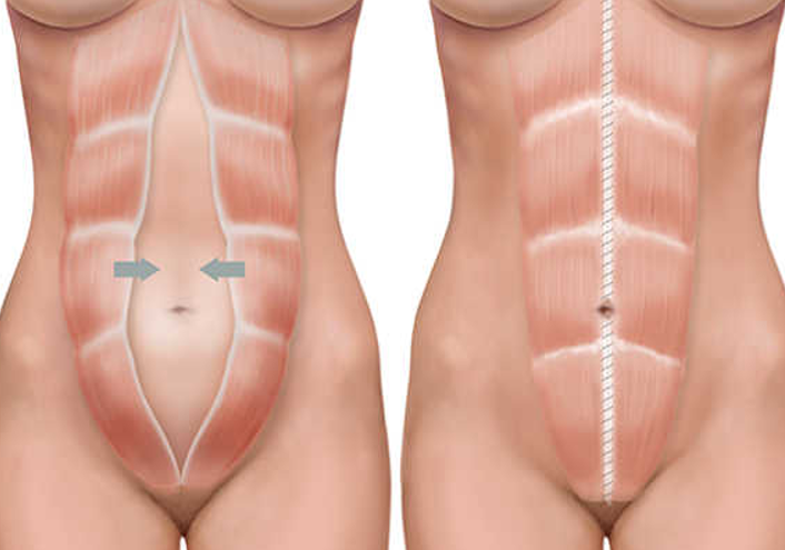 diferencias entre liposuccion y abdominoplastia destacada