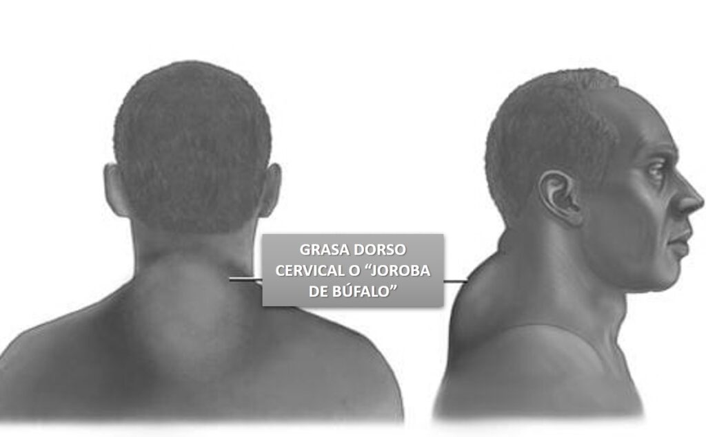 precio liposuccion joroba de bufalo destacada