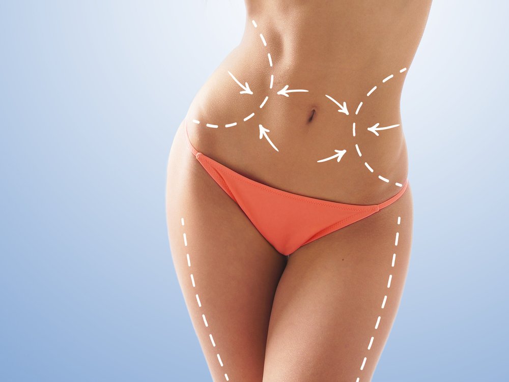 What Is Smart Liposuction.jpg
